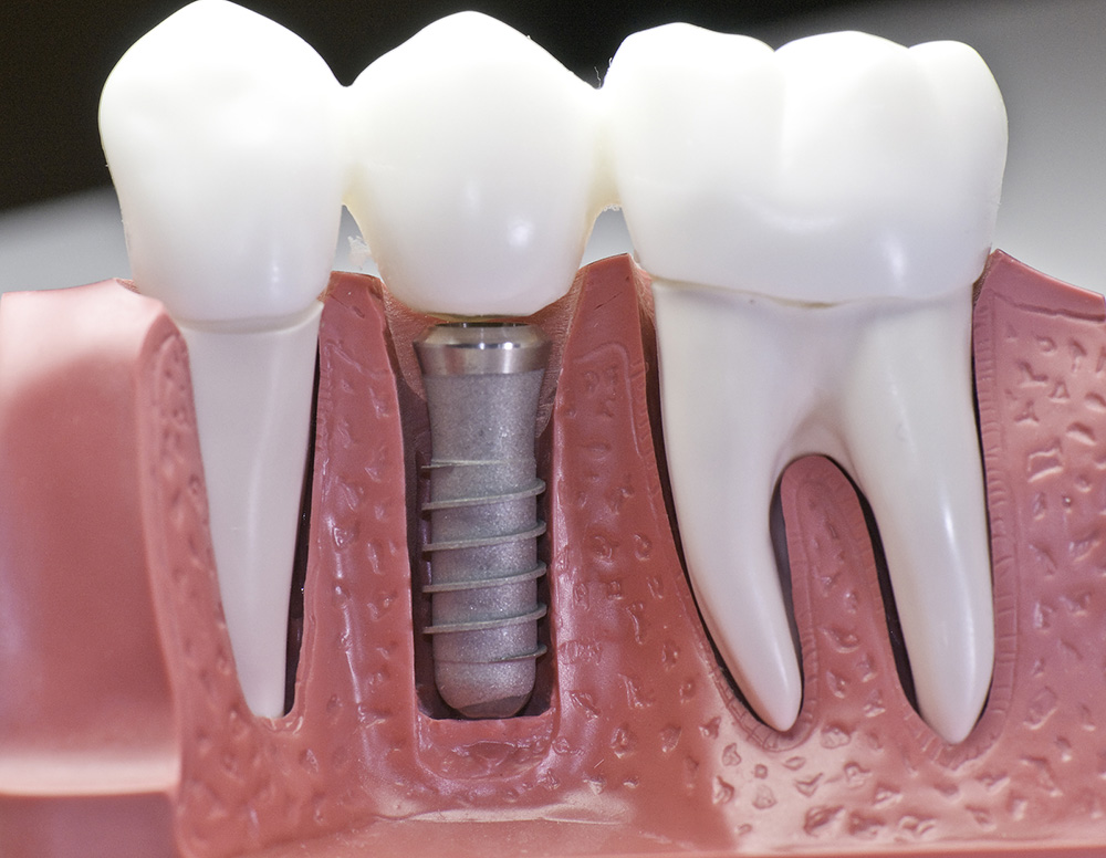 Dental Implant rockland county